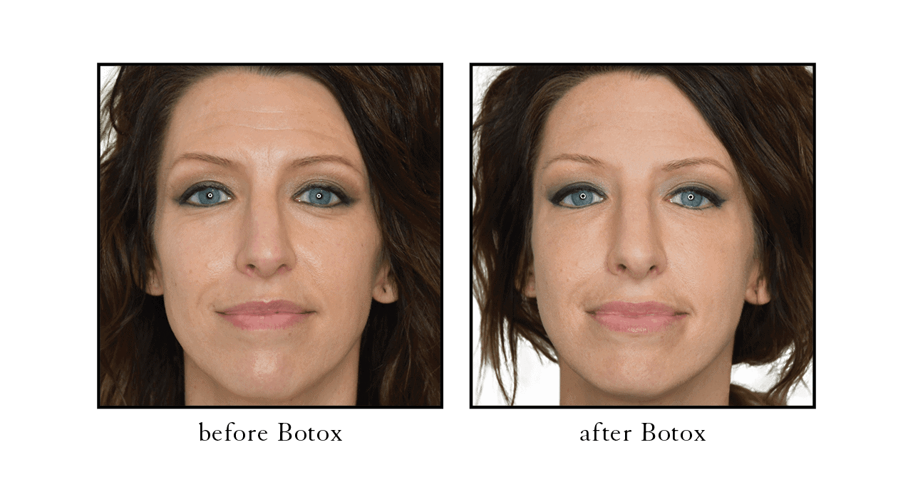 botox atlantic beach beforeafter botox atlantic beach beforeafter