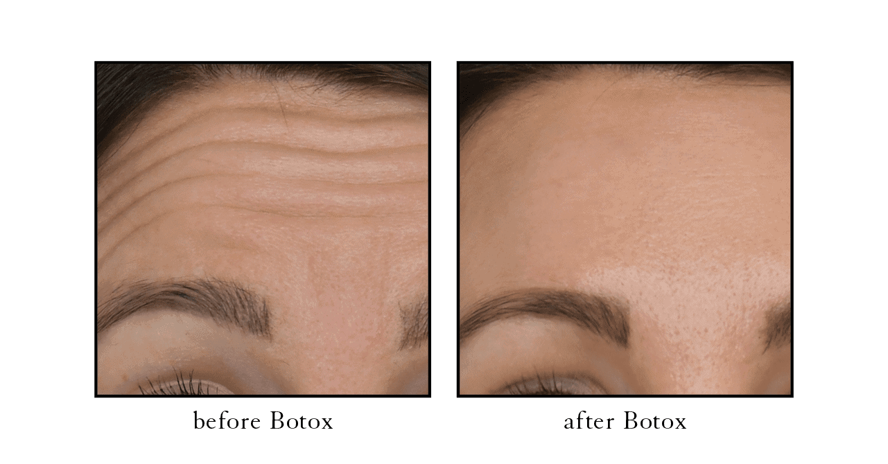 botox atlantic beach serene botox atlantic beach serene