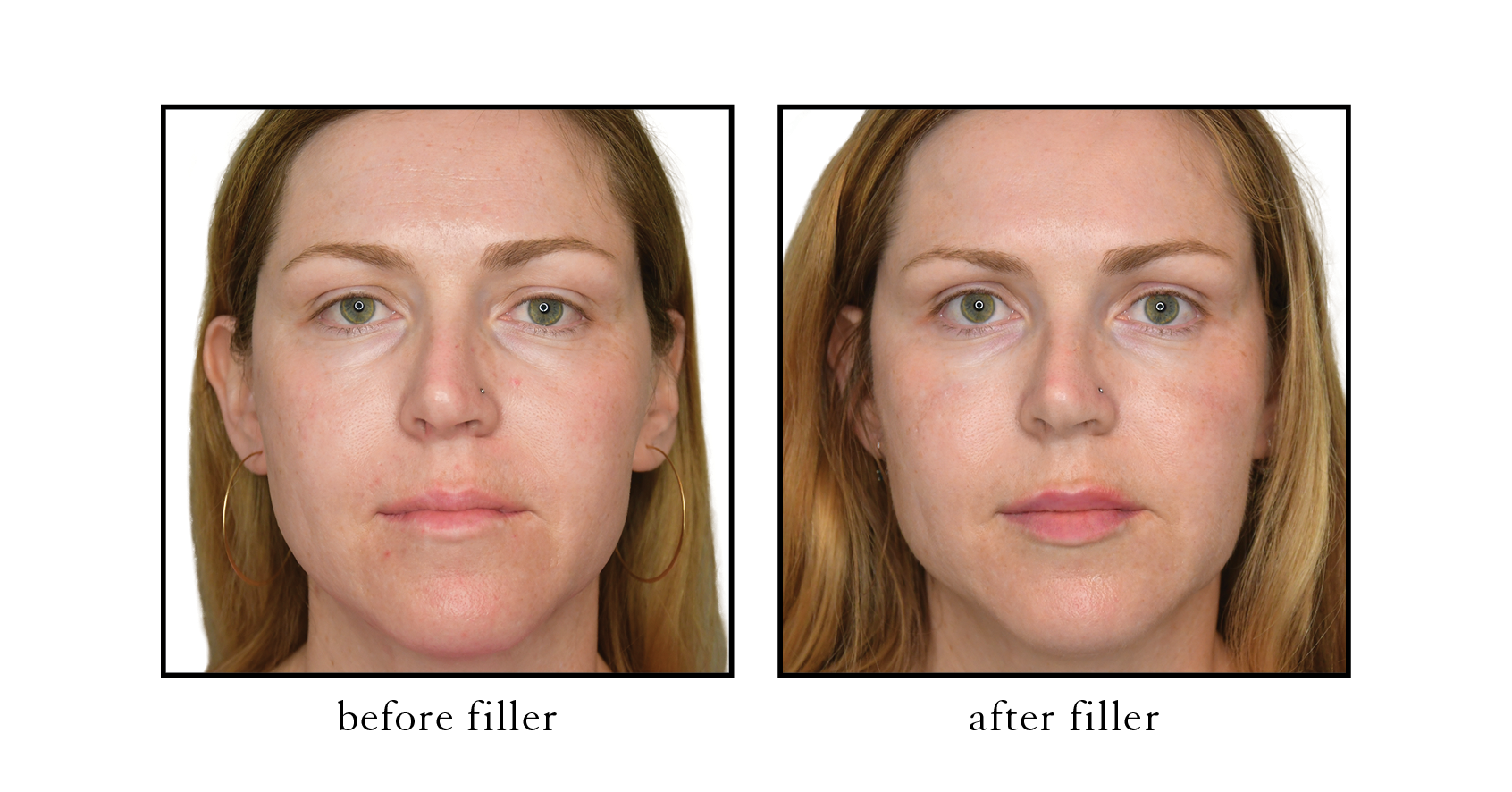 Atlantic Beach Dermal Filler Before and After Atlantic Beach Dermal Filler Before and After