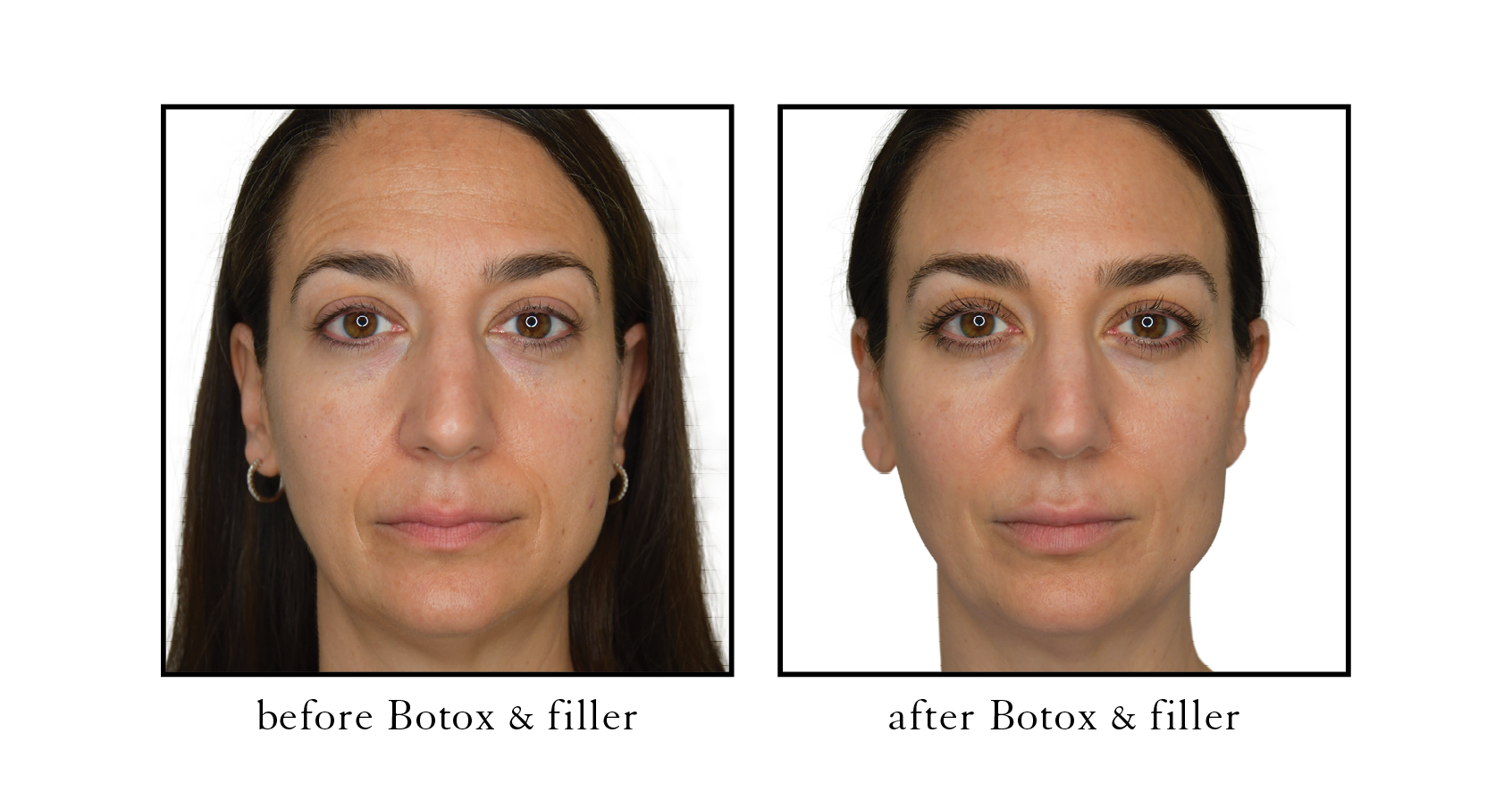 Serene Atlantic Beach Botox and Filler 2 Serene Atlantic Beach Botox and Filler 2