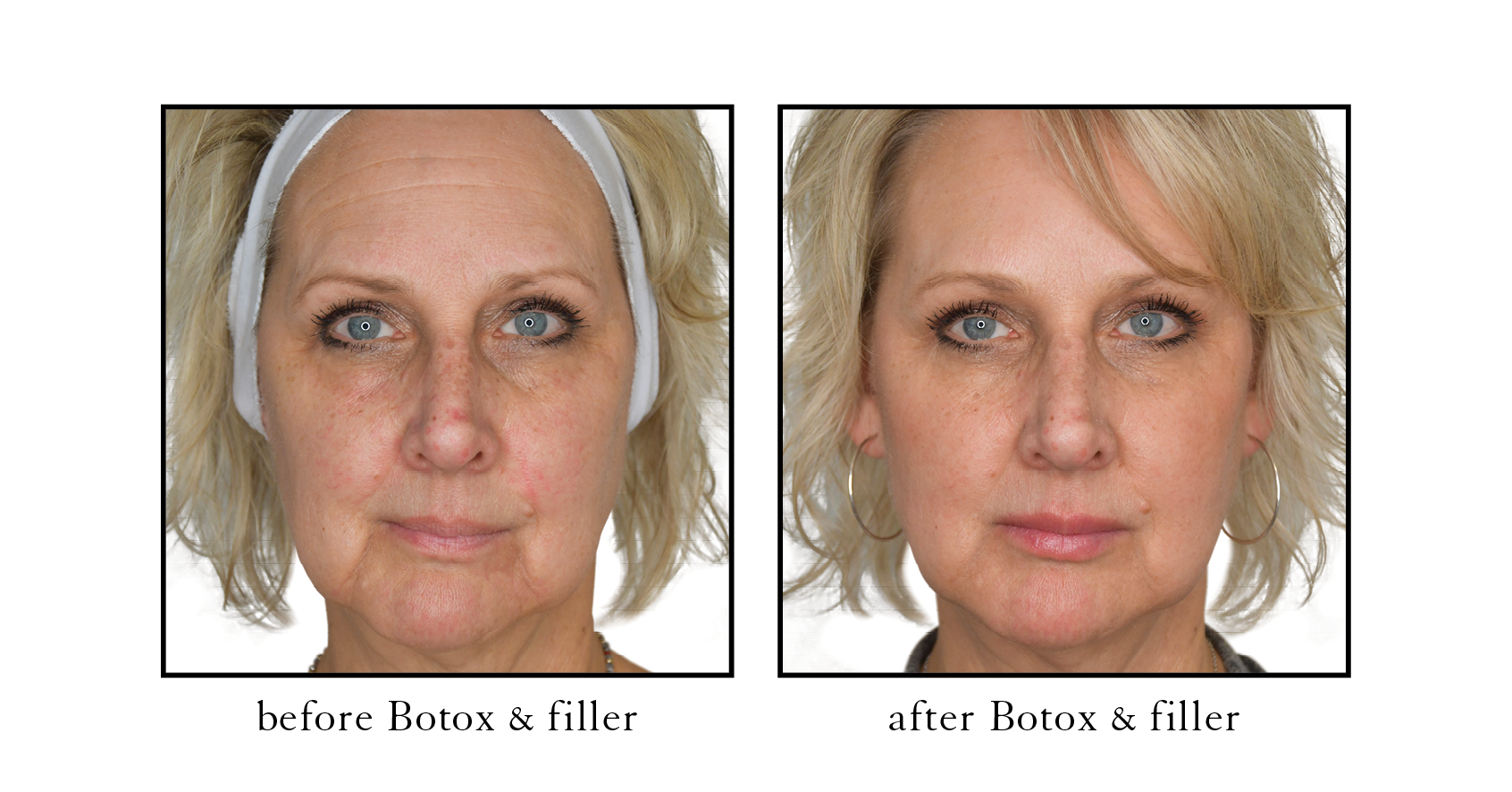 Serene Atlantic Beach Botox and Filler Serene Atlantic Beach Botox and Filler