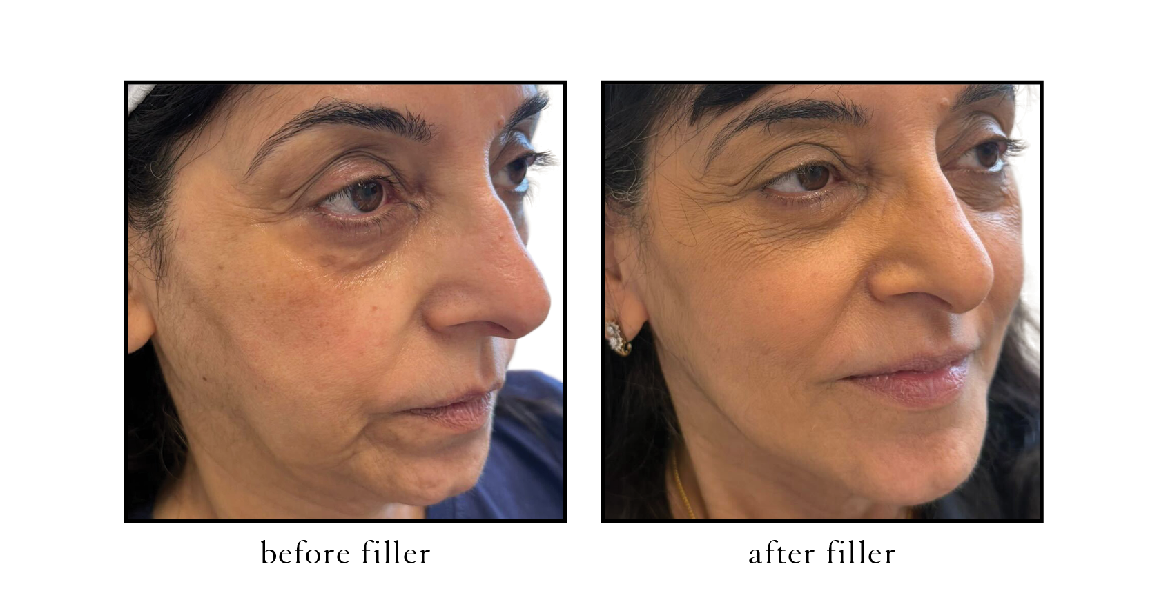 Serene Atlantic Beach Dermal Filler Serene Atlantic Beach Dermal Filler