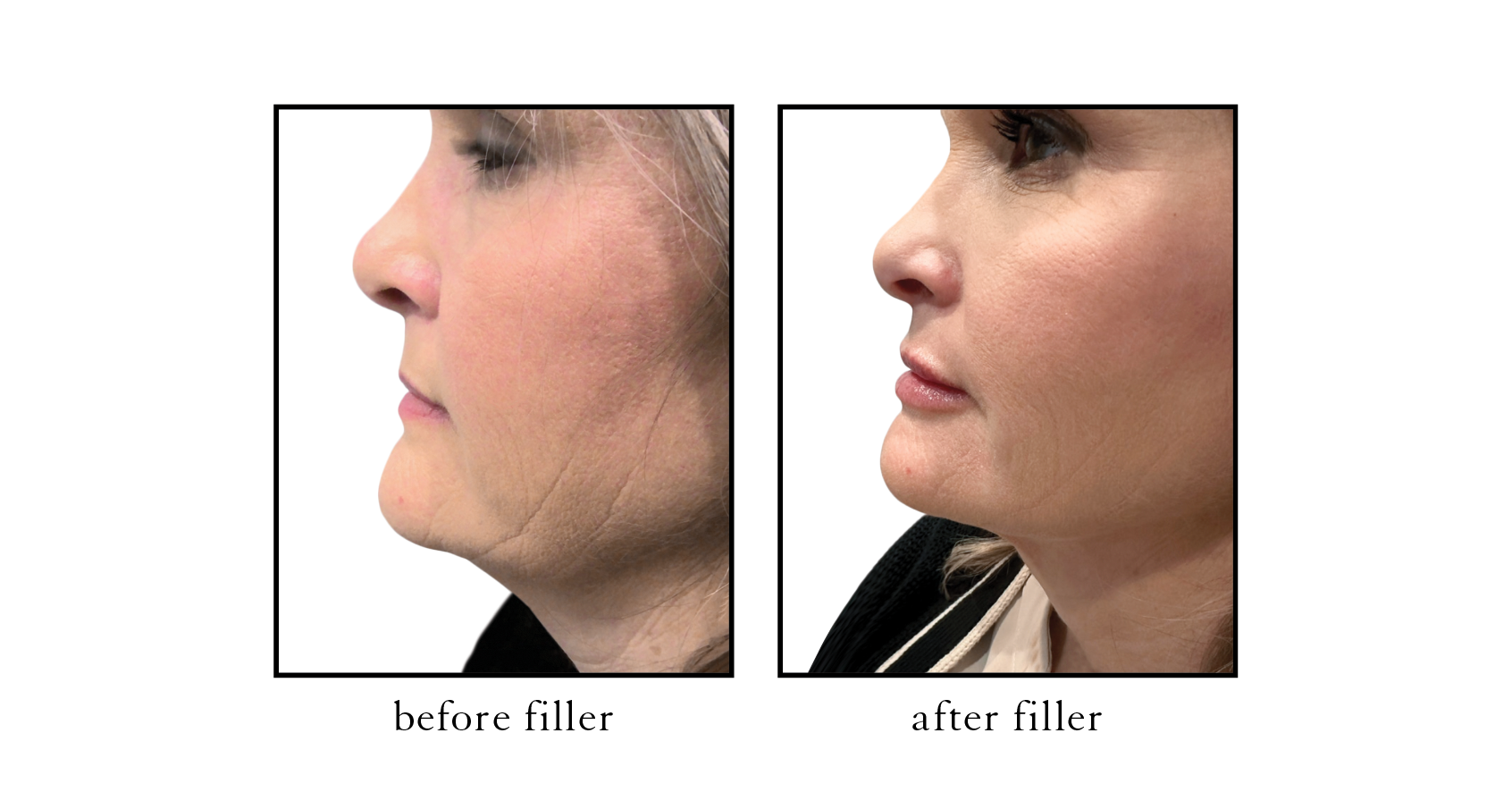 Serene Atlantic Beach Filler Face Balancing Serene Atlantic Beach Filler Face Balancing