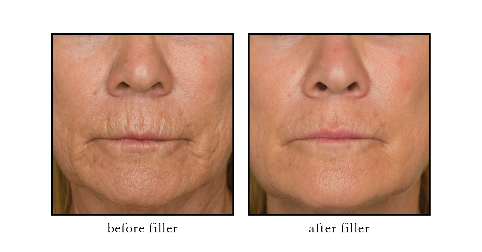 Serene Atlantic Beach Lip Line Filler Serene Atlantic Beach Lip Line Filler