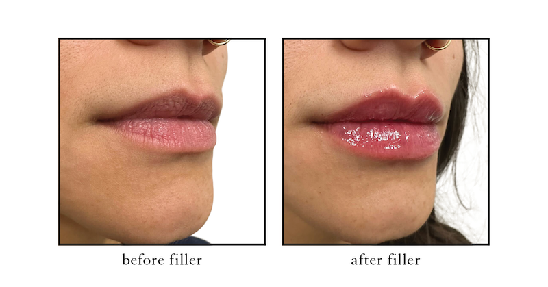 filler for lips in Atlantic Beach Serene filler for lips in Atlantic Beach Serene